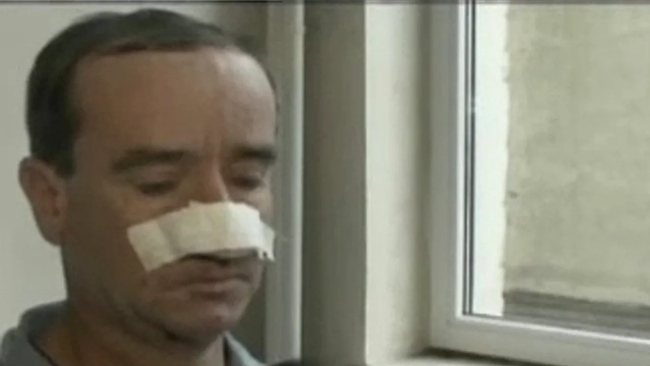 Un bărbat a ajuns la spital după ce a fost muşcat de nas - VIDEO