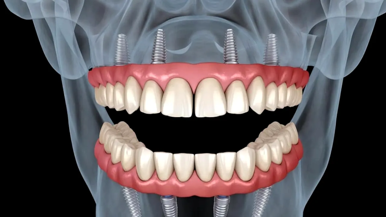 Cum se desfășoară procedura de implant dentar și ce trebuie să știi înainte (P)