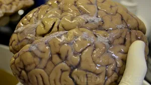 Primul creier uman aproape complet format, obţinut în laborator, în Statele Unite ale Americii
