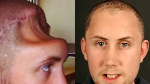 Craniul deformat al unui bărbat agresat în Marea Britanie, reconstruit de chirurgi - FOTO