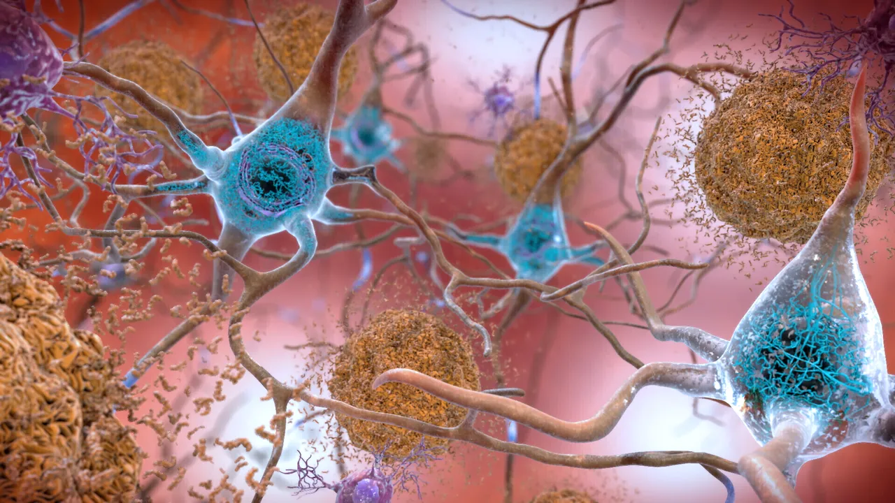 Japonezii obţin aprobarea FDA pentru un medicament împotriva agitaţiei cauzate de Alzheimer