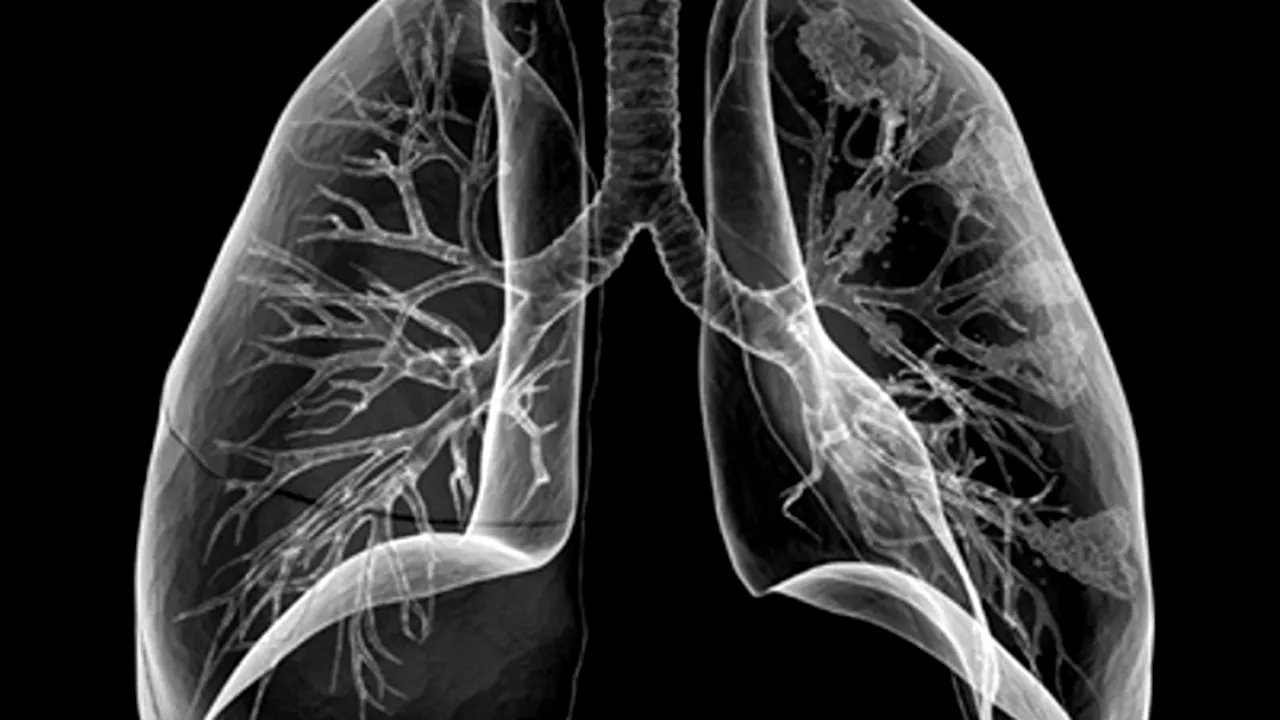 STUDIU: Primele semne ale cancerului pulmonar ar putea fi detectate cu ajutorul unui test respirator