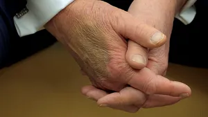 O vânătaie pe mâna lui Donald Trump a generat speculaţii privind starea sa de sănătate
