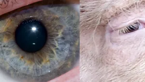Un implant ocular revoluţionar din colagen de porc a redat vederea la 14 nevăzători