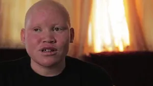 Oamenii cu albinism, ucişi în Tanzania pentru vrăjitorie. Mărturiile dramatice ale victimelor - VIDEO