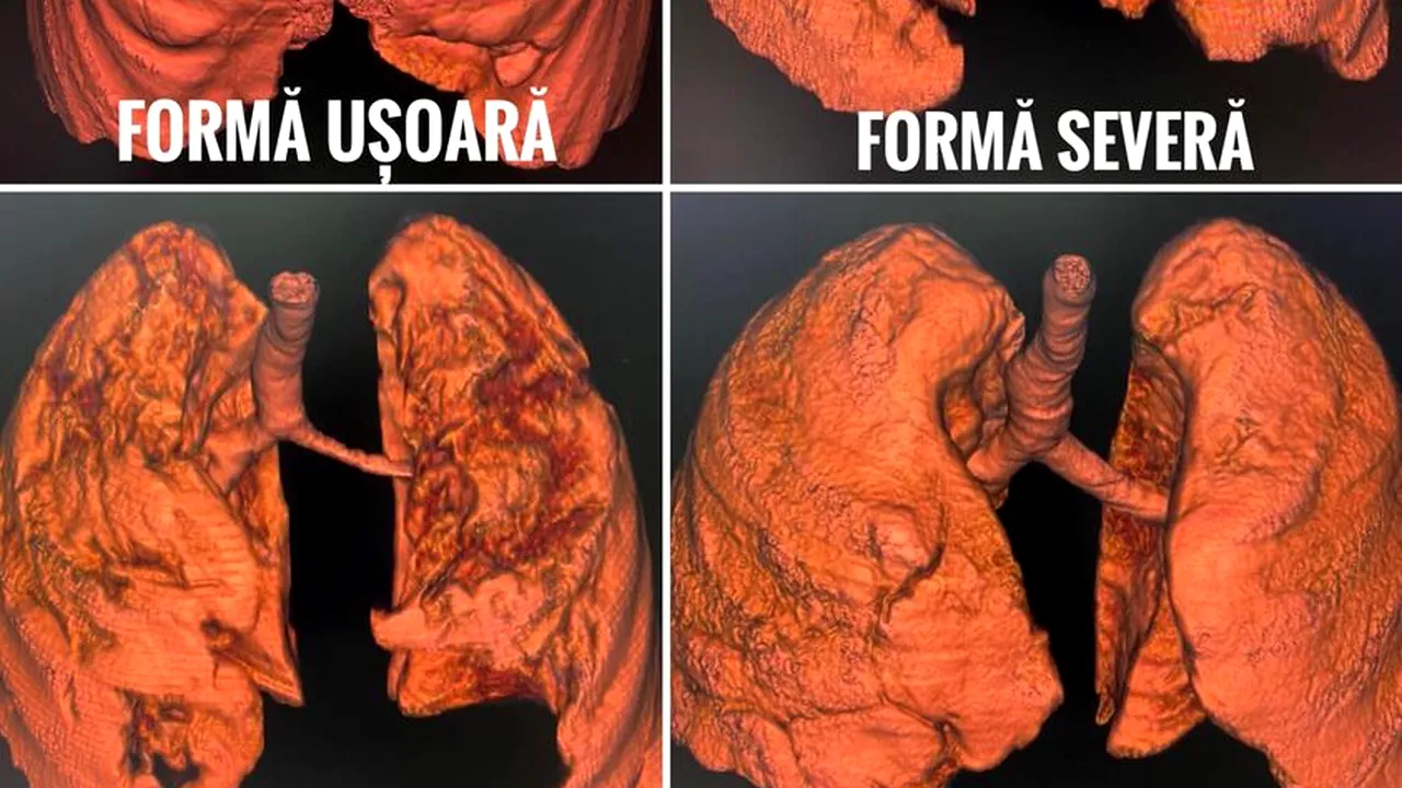 CNCAV a publicat tomografiile computerizate a 4 pacienţi nevaccinaţi, bolnavi de COVID-19