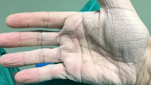 FOTO | Imagine şocantă cu mâna unui medic după intervenţii de 12 ore: Sunt 30 de grade în blocul operator