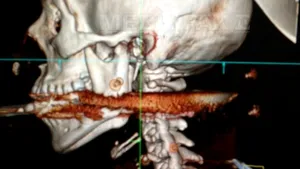 CAZ INEDIT: O femeie a supravieţuit după ce un harpon i-a străpuns faţa