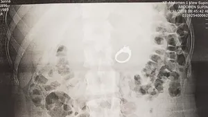 Când visele se împletesc cu realitatea: Motivul pentru care o femeie şi-a înghiţit propriul inel de logodnă  | FOTO, VIDEO