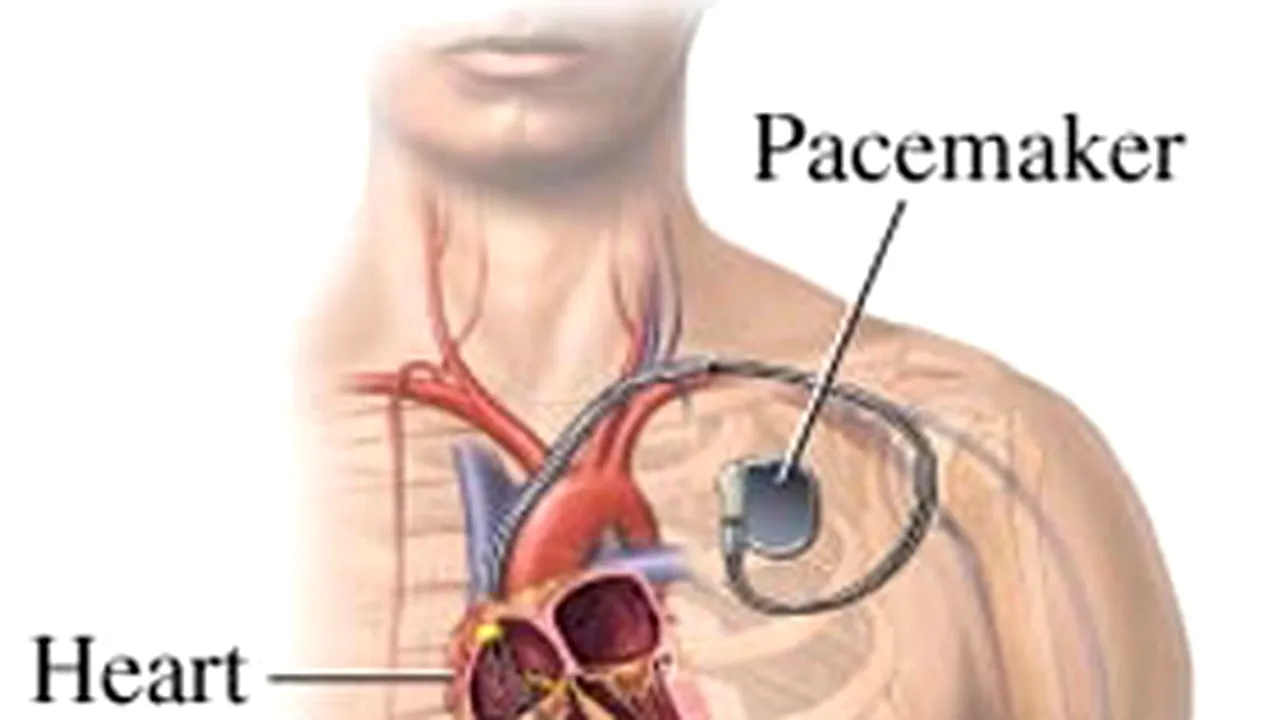 Pacemakerele şi defibrilatoarele cardiace, vulnerabile la pirateria informatică