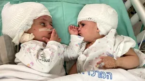 Israel: Intervenţie rară de separare a două gemene siameze unite la nivelul capului