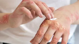 Pielea pierde apă iarna: Sfaturile medicilor pentru protecție