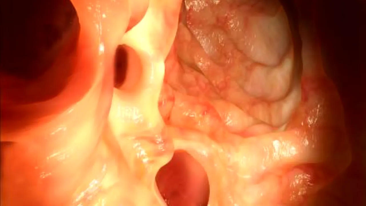 Cancerul colorectal este în creştere în rândul tinerilor: confirmarea vine de la o recentă cercetare americană

