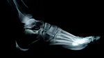 Şanse mai mari de prevenire a fracturilor. Tehnologia care vede dincolo de radiografii