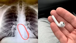 Căştile wireless pot fi periculoase în timpul somnului. Un bărbat a fost operat de urgenţă după ce medicii i-au găsit un AirPod în esofag