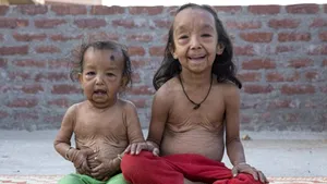 Imagini CUTREMURĂTOARE: Boala care transformă copiii în bătrâni