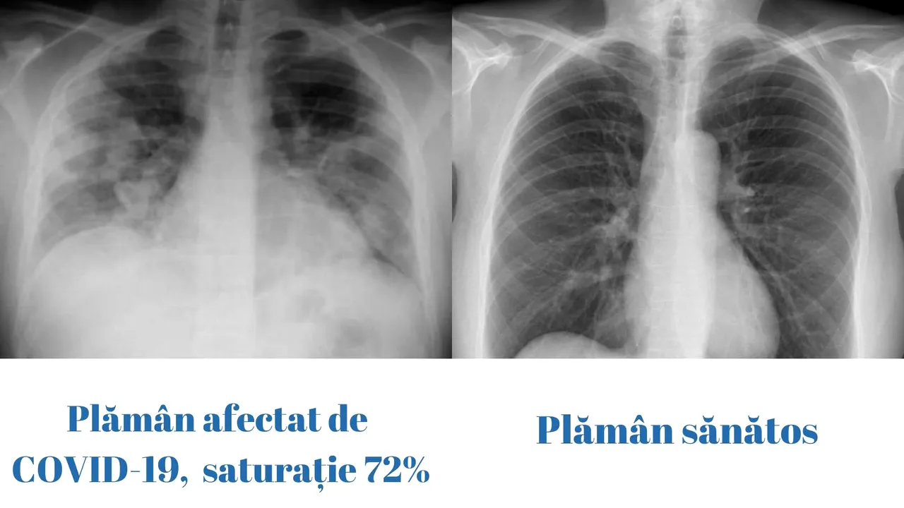 CNCAV: Cum arată un plămân afectat de COVID-19 faţă de un plămân sănătos