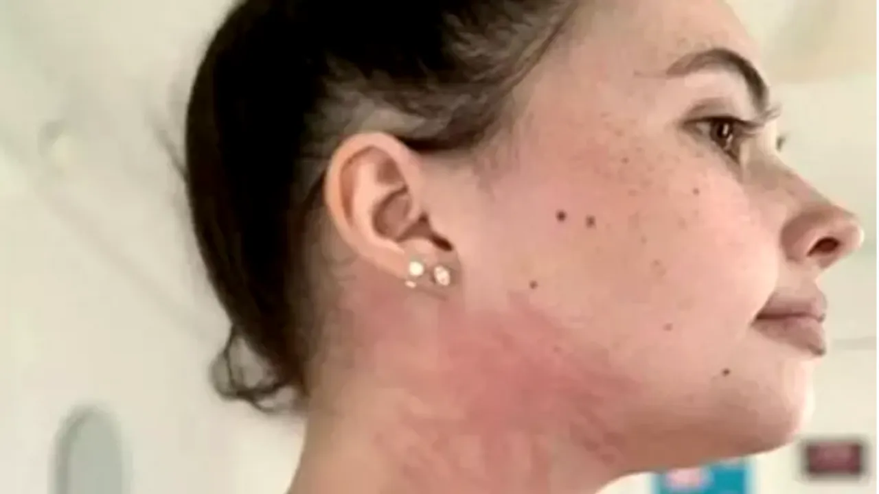 Boala rară de care suferă o tănâră în vârstă de 25 de ani: lacrimile îi provoacă răni şi bea doar lapte


