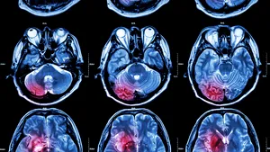 Cazul straniu al atacului SONIC. Tomografiile diplomaţilor americani, care s-au îmbolnăvit în condiţii misterioase în Cuba, arată o „micşorare” a creierului | FOTO, VIDEO