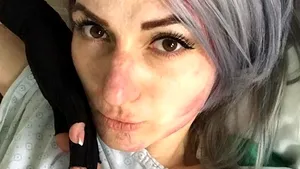 Colectiv, 3 ani. Adina Apostol, supravieţuitoare: Sunt internată, asta spune multe cred. Fac operaţii, bandaje... Este foarte obositor