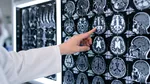 Semnele unui accident vascular cerebral. Medicii explică în ce situații trebuie să suni la 112