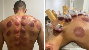 Totul despre Terapia Hijama. De ce o iubesc fotbaliştii şi de ce medicii nu o recomandă