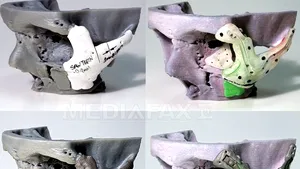 Reconstrucţia facială: Rezultate incomparabile, graţie imprimantelor 3D - FOTO