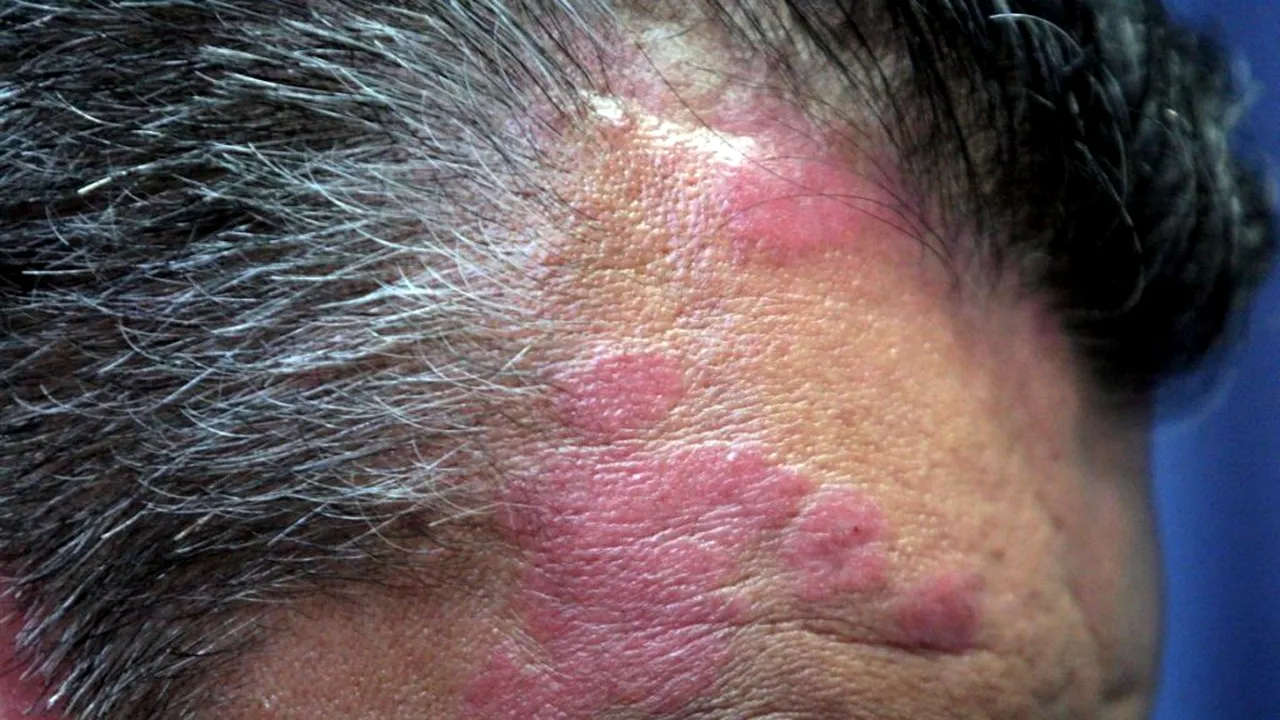 Speranță pentru cei care suferă de psoriazis: o nouă tehnică fotonică reușește să îl trateze fără efecte secundare