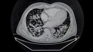 Descoperirea unui medic francez despre Covid-19. A analizat peste 2.500 de radiografii toracice