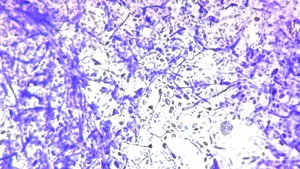 O ciupercă mortală se raspândește și face ravagii în spitalele din Europa. Ce se știe până acum despre ea