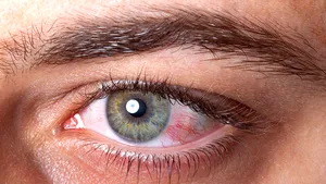 Bizar: Ce au observat medicii la ochii unor pacienţi cu coronavirus. A persistat chiar şi 21 de zile