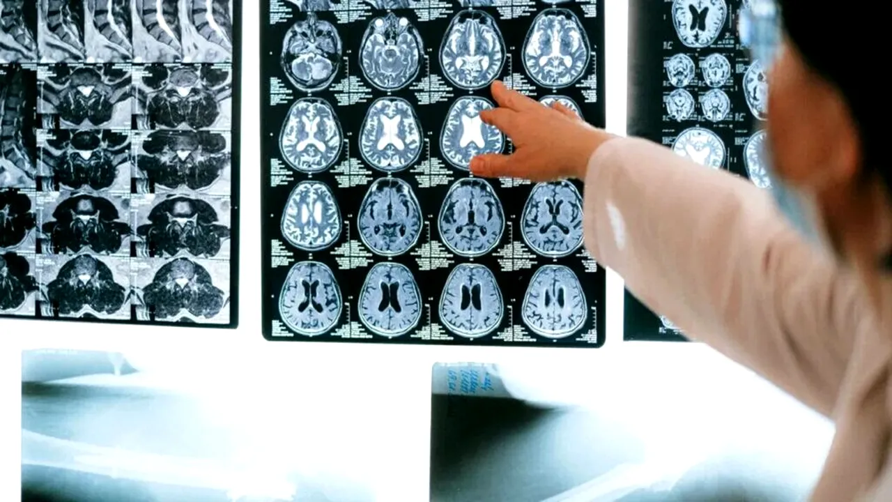 Record îngrijorător: Cel mai tânăr pacient cu Alzheimer din lume