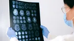 Un nou studiu arată că țările sărace sunt cele mai afectate de Alzheimer la nivel mondial