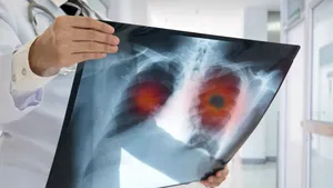 Un medicament revoluţionar reduce tumorile pulmonare. 77% dintre pacienţi au avut rezultate pozitive