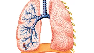 Cel puţin un milion de români suferă de bronşită cronică obstructivă. Mai puţin de 50% au acces la servicii medicale