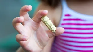 Peste 4.6 milioane de adulţi din SUA suferă de alergie la alune. Cei mai mulţi o dezvoltă la maturitate