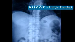 Un bulgar a înghiţit un kilogram de cocaină. Vezi aici radiografia
