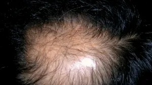 STUDIU: Un posibil tratament împotriva calviţiei ar putea fi dezvoltat cu ajutorul leucocitelor