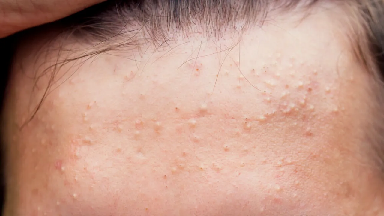 Acid salicilic pentru acnee: protocol complet în 3 pași (P)