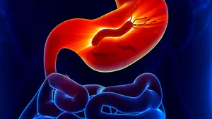 O bacterie din copilărie ar putea cauza 15 milioane de cazuri de cancer
