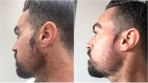 Viaţa unui bărbat, salvată de un frizer. Acesta i-a spus că ar fi bine să îşi facă un control, după ce a descoperit ceva suspect în timp ce îl tundea