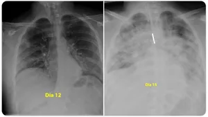 Cum s-au degradat în 3 zile plămânii unui tânăr de 28 ani infectat cu coronavirus. 