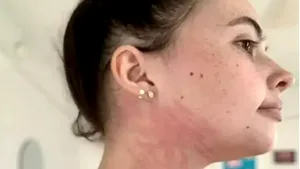 Boala rară de care suferă o tănâră în vârstă de 25 de ani: lacrimile îi provoacă răni şi bea doar lapte


