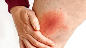 Sfaturi practice în caz de muşcătură de căpuşă