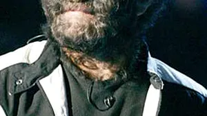 Cele mai ciudate boli din lume