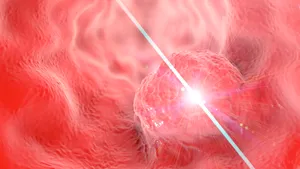 Laserul minune care îndepărtează în totalitate cancerul. Când va fi gata