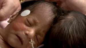 Braşov: Siamezii uniţi în zona capului au murit (Video)