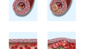 Studiu. Covid-19 ar putea ucide prin tromboză şi nu prin pneumonie, cea mai cunoscută complicaţie