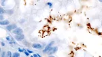 Cancerul care poate fi prevenit. Ce spune un studiu nou despre infecții