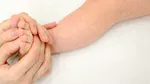 Pacienții cu dermatită atopică: efecte severe după tratamentul îndelungat cu corticosteroizi